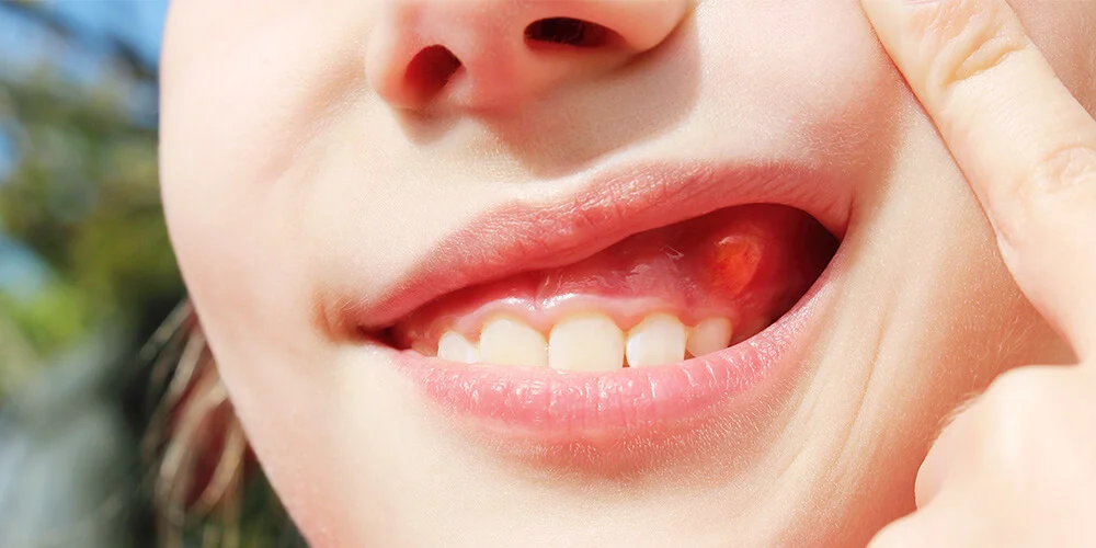 Киста корня зуба, чем опасна и как лечить?