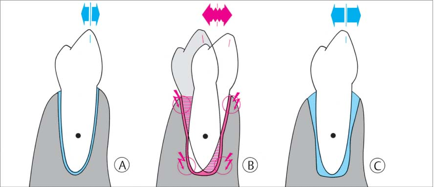 Степени подвижности зубов